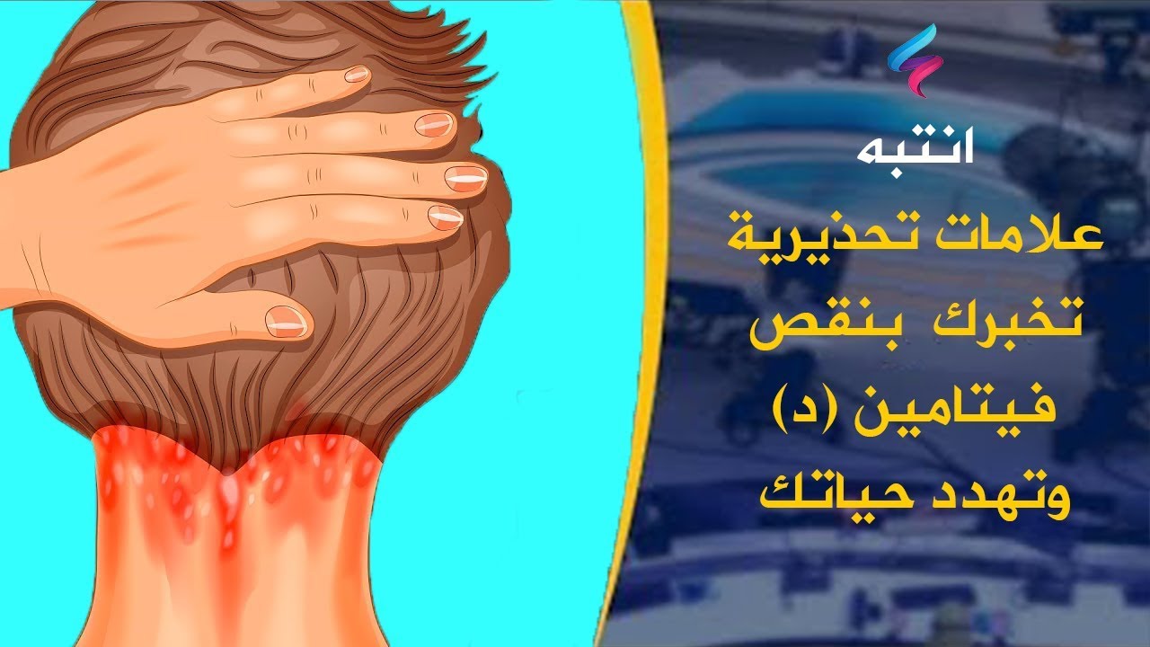 نقص فيتامين د , اسباب واعراض نقص فيتامين د