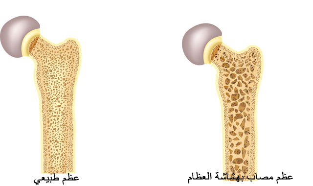 علاج هشاشة العظام - علامات هشاشة العظام 11069