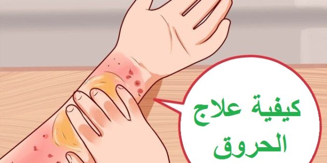 علاج الحروق , طرق لمداواة الحرق بالمنزل