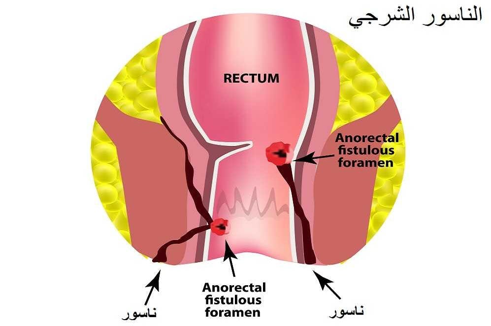 ما هو الناسور 1594 1