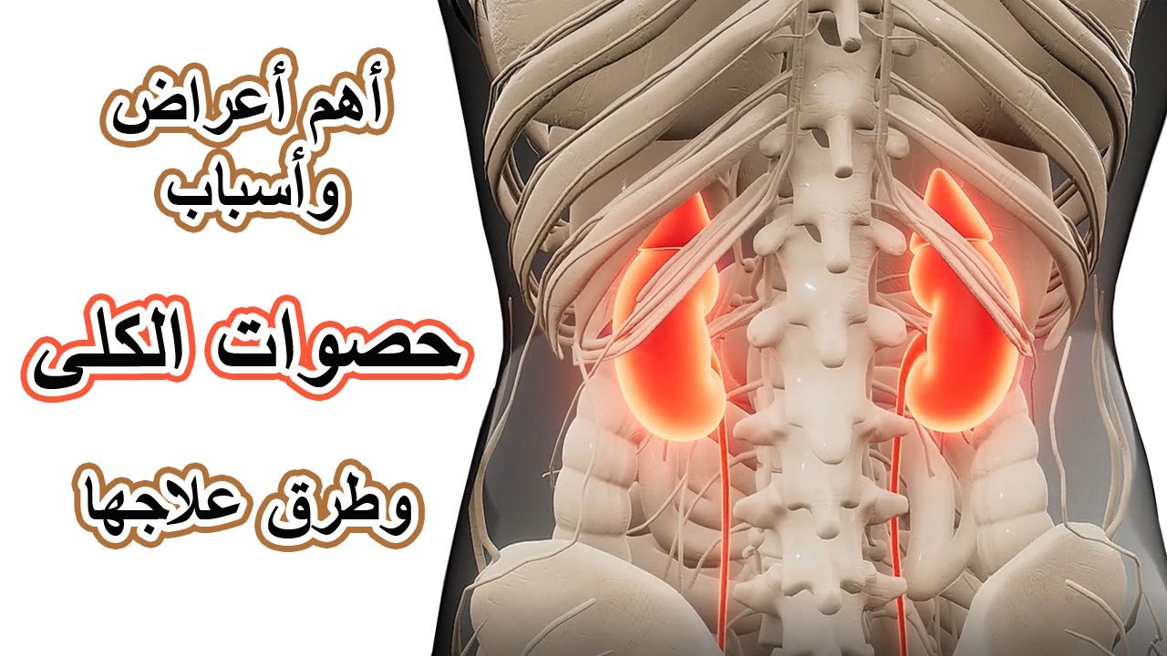 اعراض حصى الكلى- تعرف على اعراض حصى الكلى 10556 2