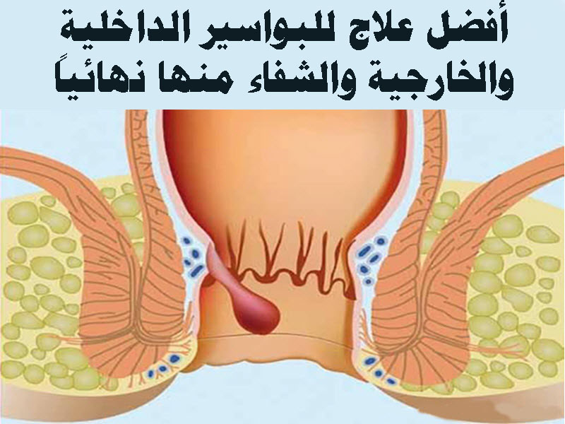 علاج البواسير 1122