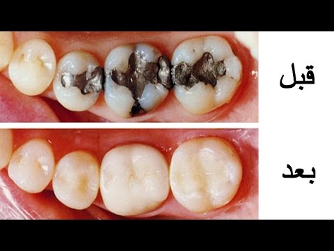 علاج تسوس الاسنان , الاهتمام بالنفس