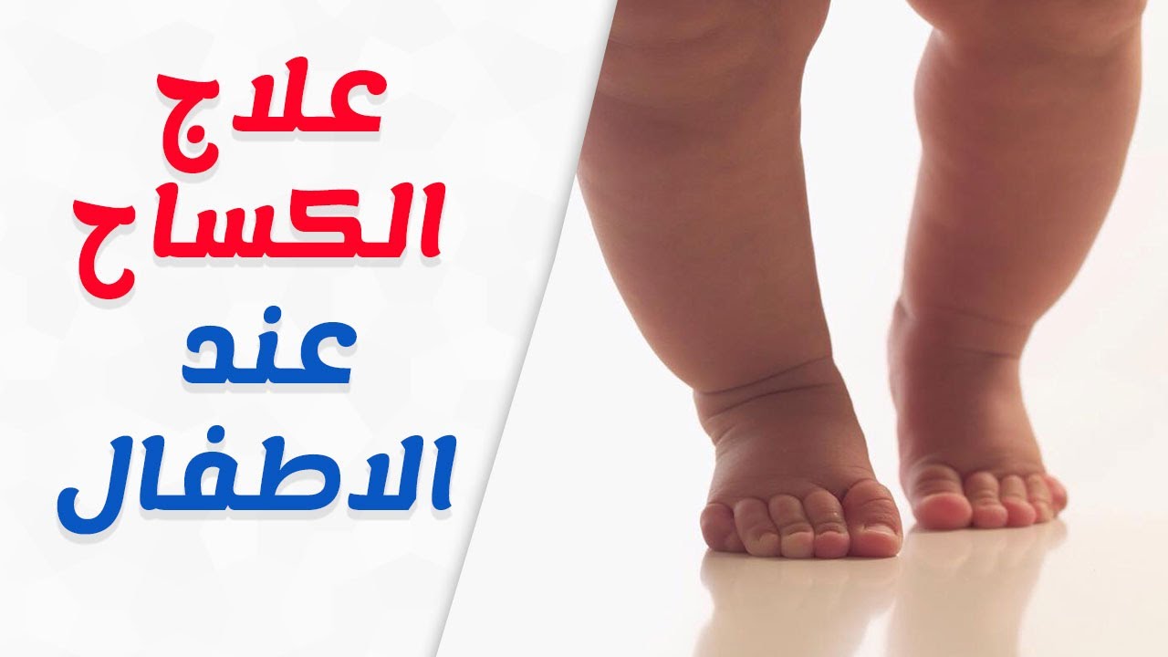 مرض الكساح - مرض المبتعدين عن الشمس