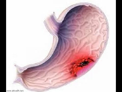 اعراض سرطان المعدة , اهم عرض لسرطان المعدة