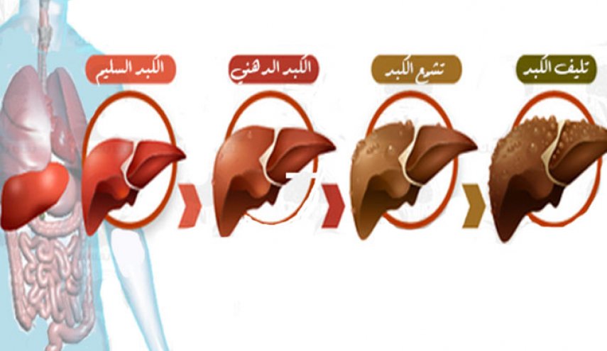 اعراض مرض الكبد