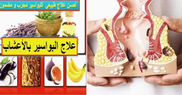 علاج سريع للبواسير