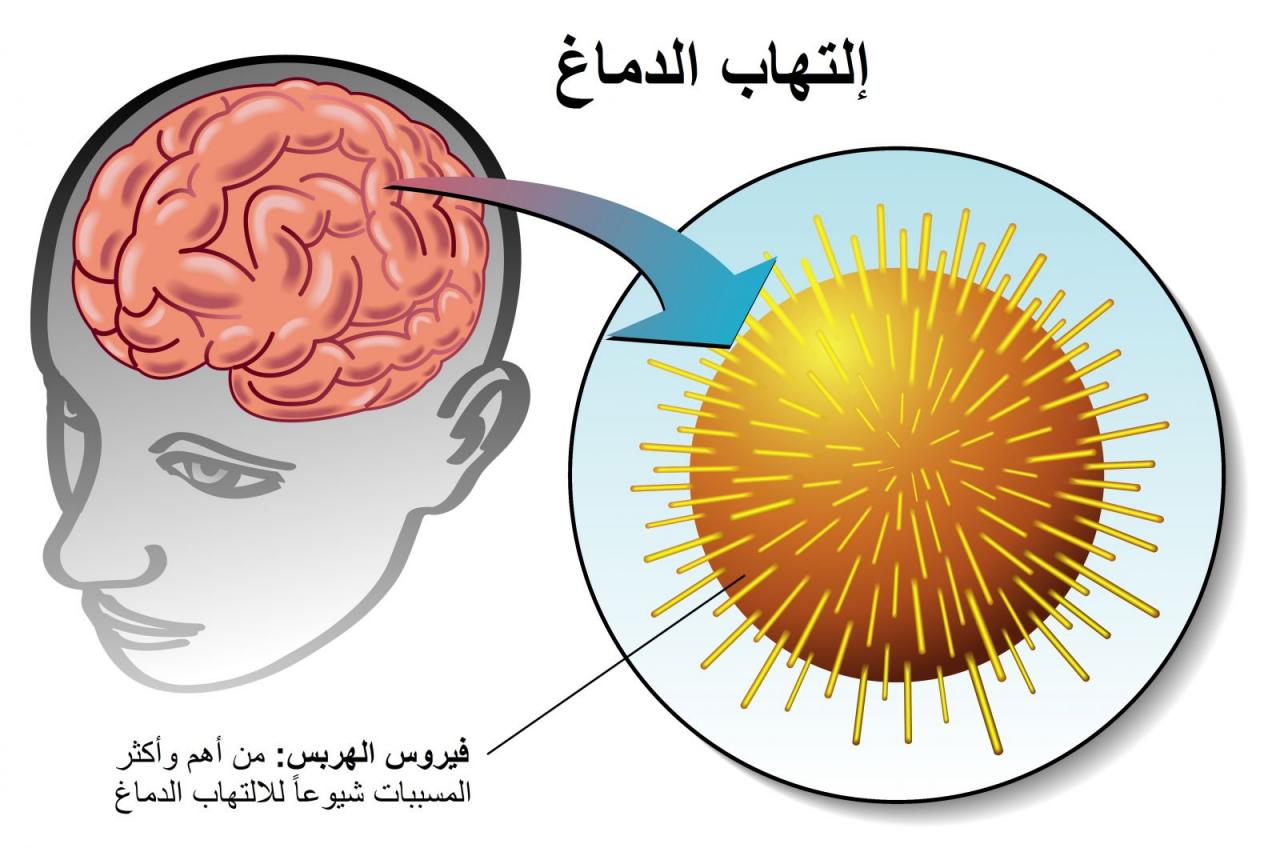 اعراض التهاب المخ , ماهي امراض المخ