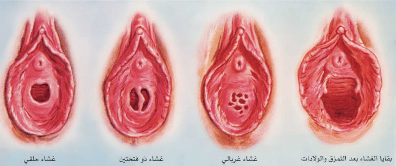 كيف يفض الزوج بكارة زوجته بالصور 1826