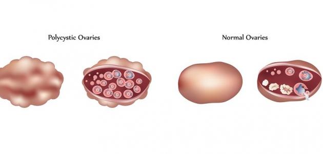 اعراض تكيس المبايض - اسباب و علاج تكيس المبايض 4679 2
