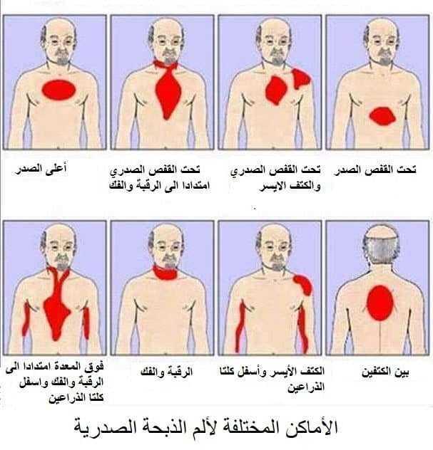 اعراض الذبحة الصدرية 1546