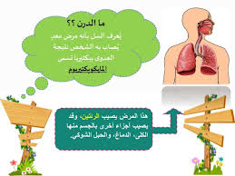 مرض الدرن - التعرف على مرض الدرن 352