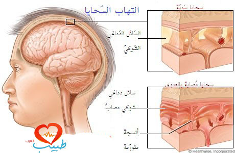 مرض السحايا - علاج مرض السحايا باسرع وقت 2516 1