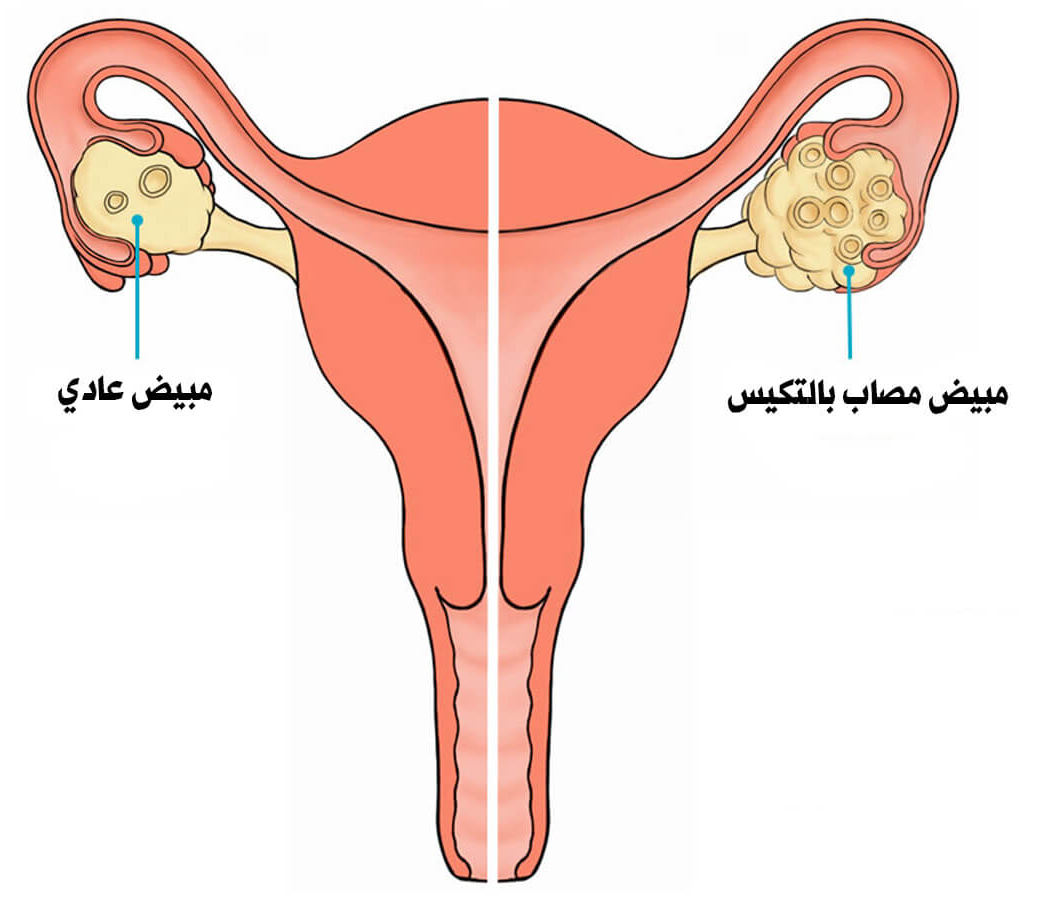 اعراض تكيس المبايض - اسباب و علاج تكيس المبايض 4679 3