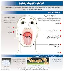 علاج التهاب الحلق