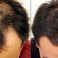 2537 3 علاج لتساقط الشعر - وصفة لكثافة الشعر في اسبوع اثرياء الحب