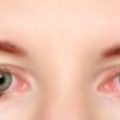 4162 2 علاج حساسية العين - علاج حساسية العين بسيط وبشكل نهائي بركة حاسم