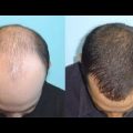 6138 2 علاج الصلع الوراثي - علاج الشعر الخفيف بنت محمد
