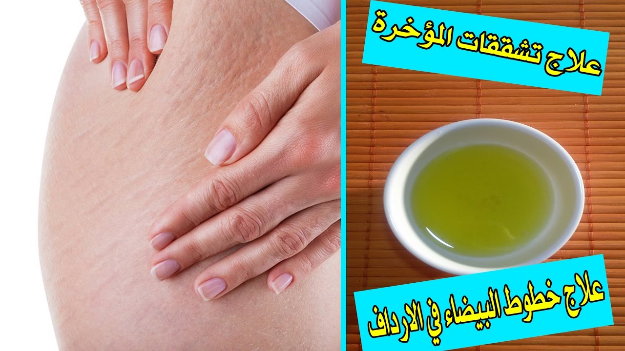 الخطوط البيضاء في المؤخرة , مشاكل المؤخرة عند النساء