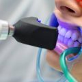 10589 1 عملية تبييض الاسنان فياض مرادي