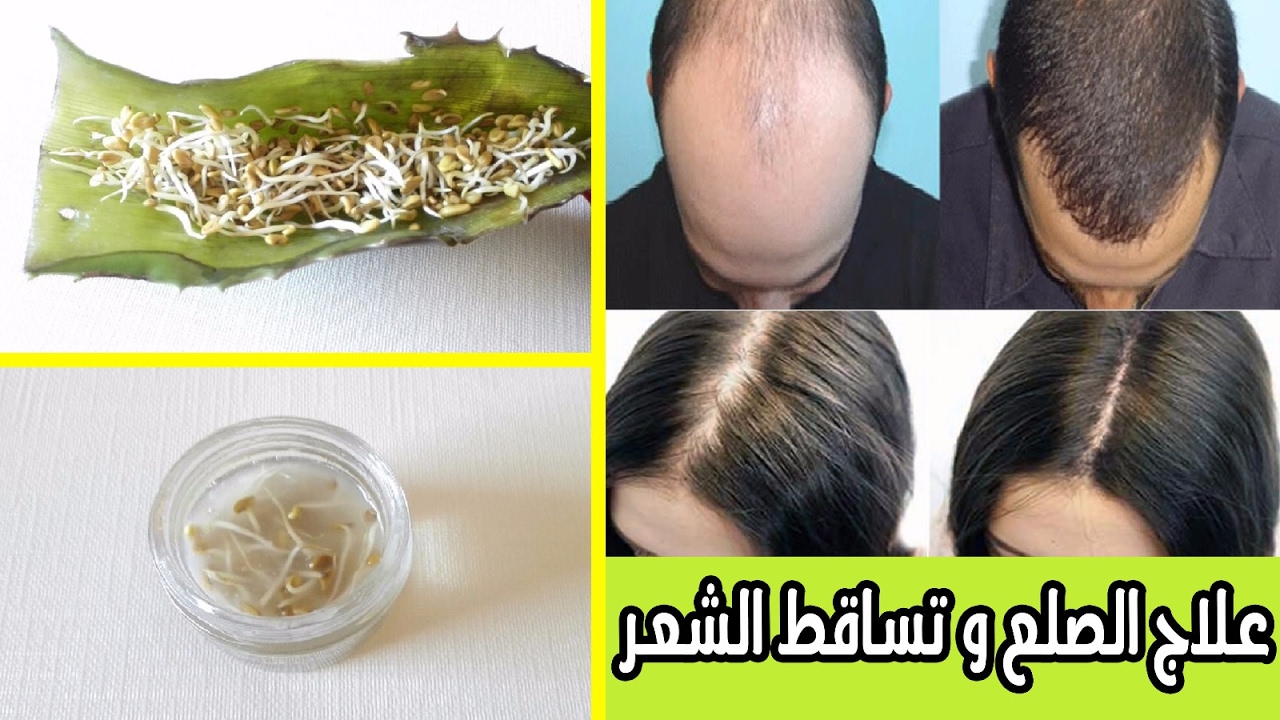 علاج تساقط الشعر , واجهى اصعب المشاكل بنفسك