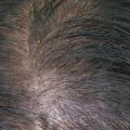 11552 3 علاج الفراغات في الشعر- تخلص من فراغات الشعر الى الابد اثرياء الحب
